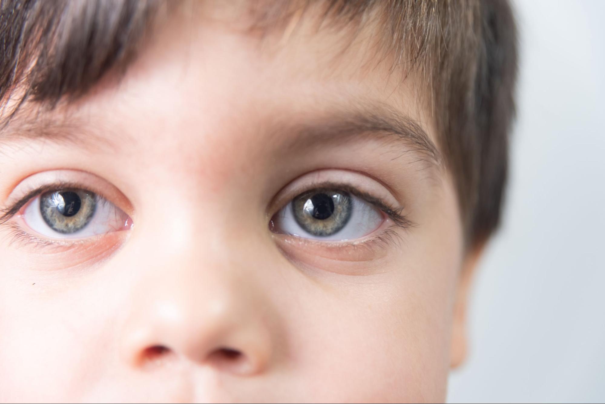 amblyopia diagnosis