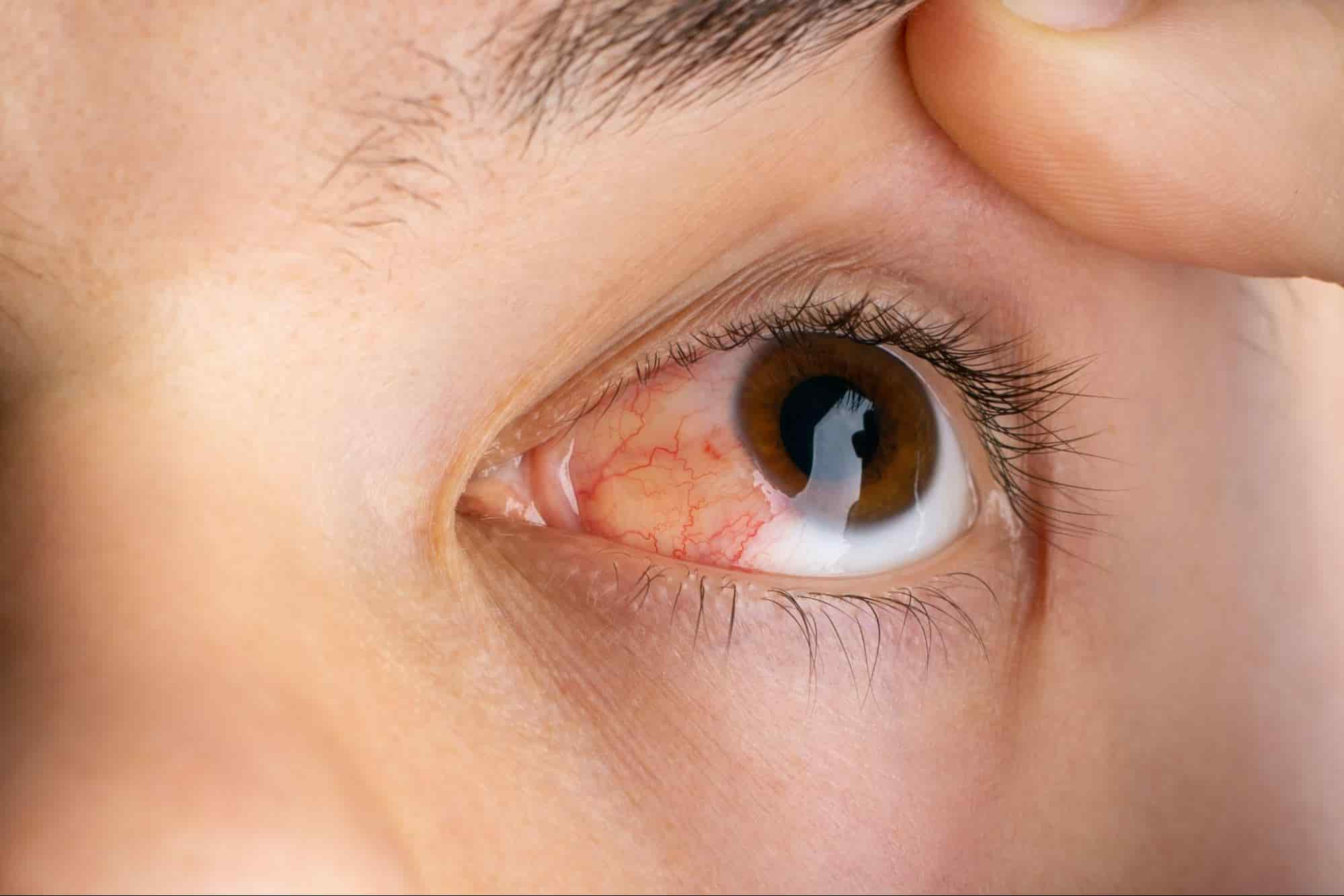 corneal abrasion vs ulcer