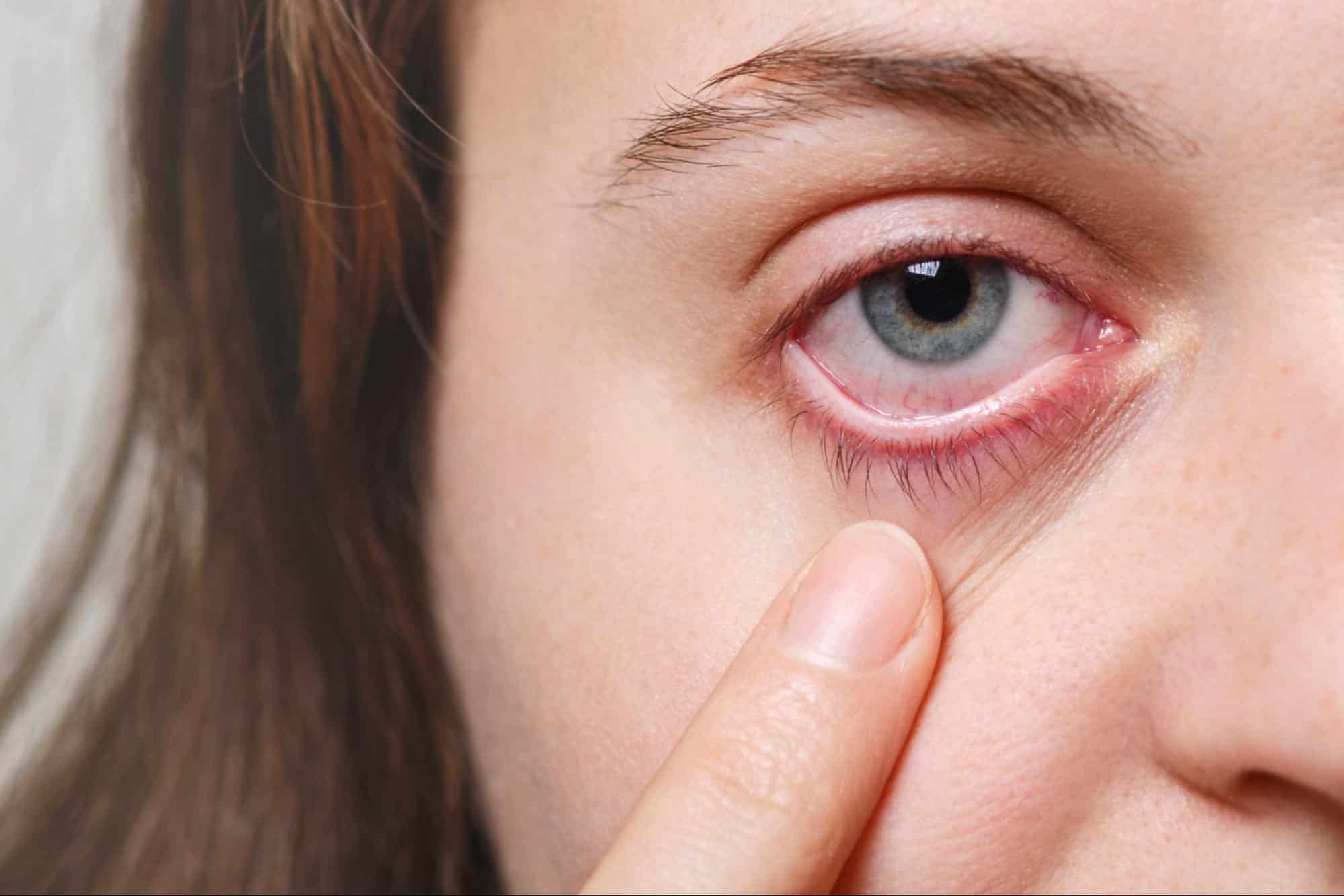 corneal ulcer