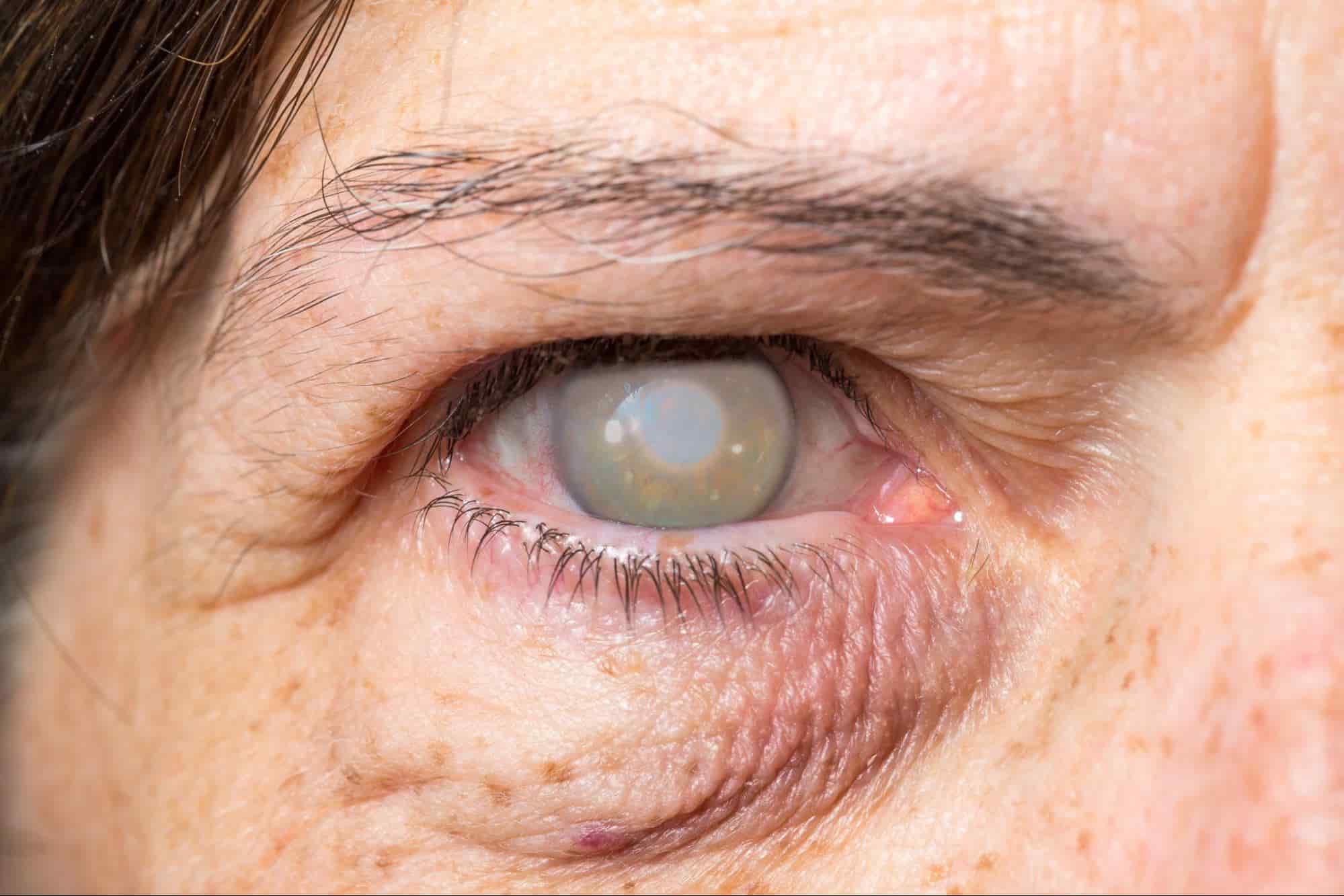 What is Cortical Cataract