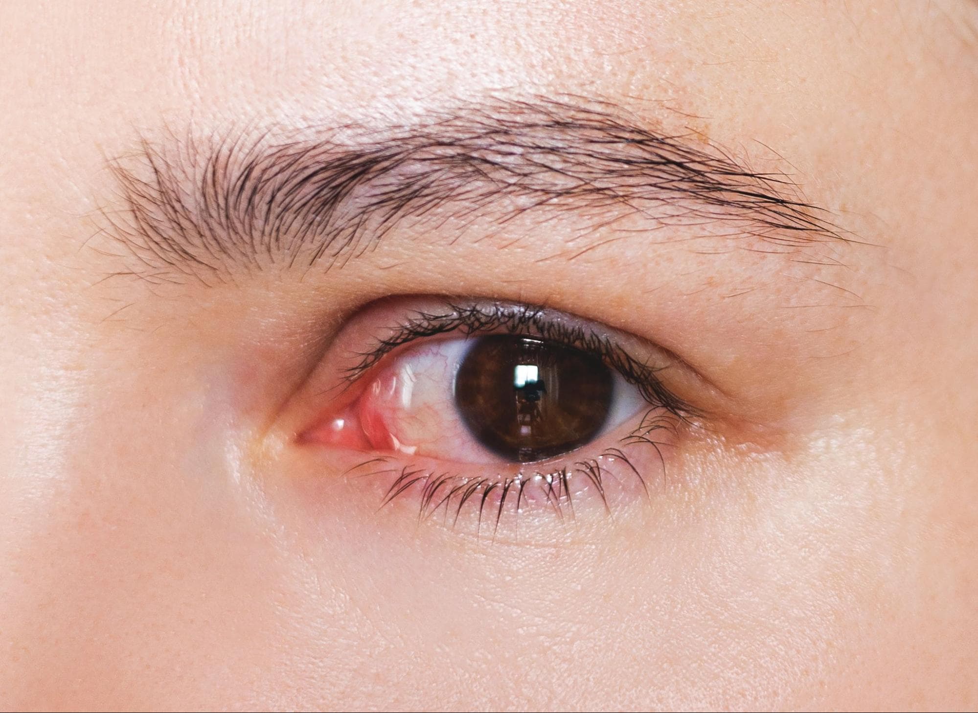 เยื่อบุตาอักเสบ อาการ