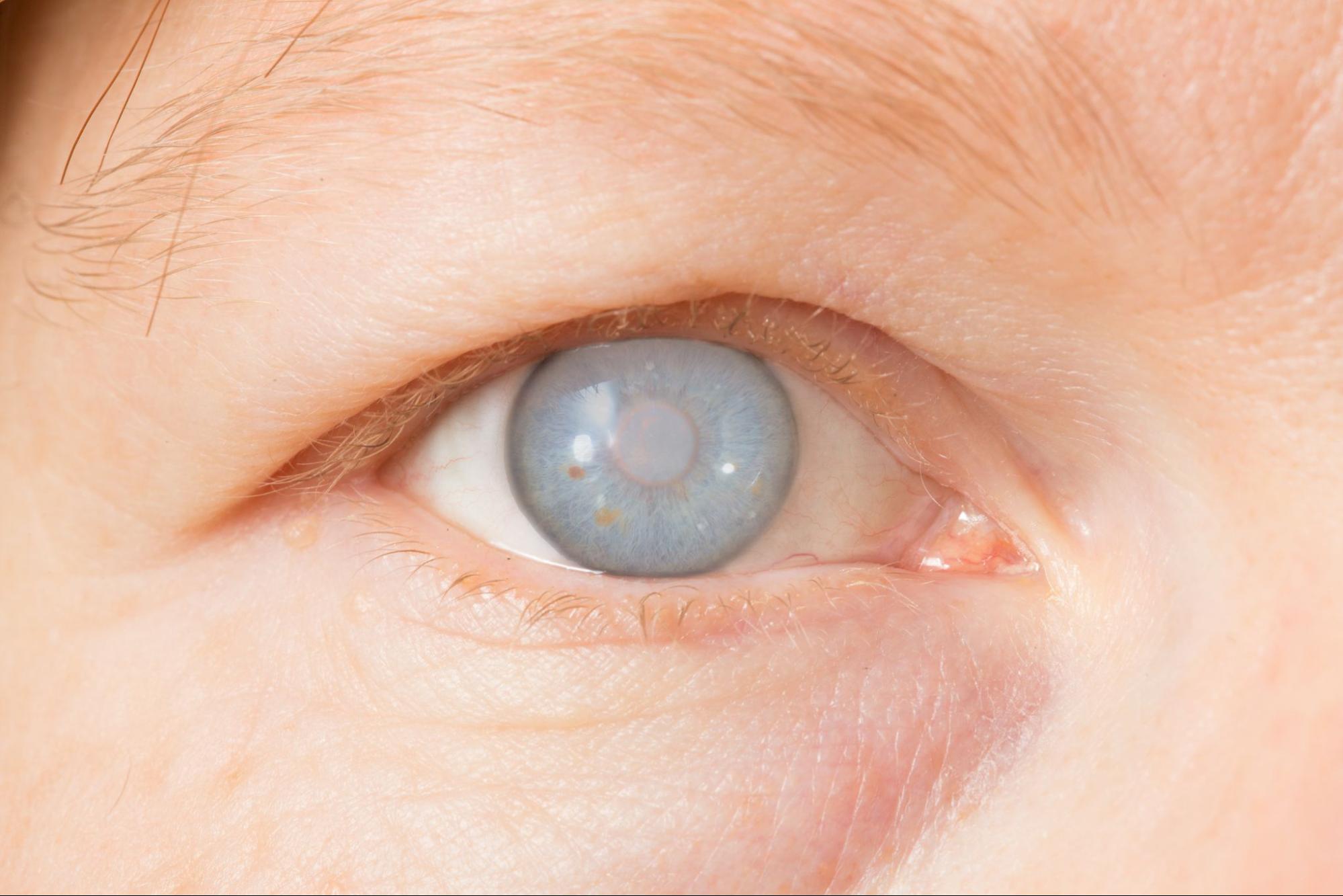 Glaucoma