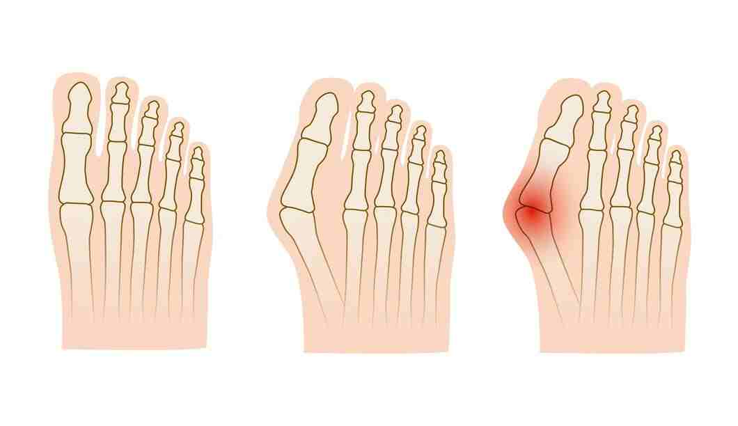 hallux valgus คือ