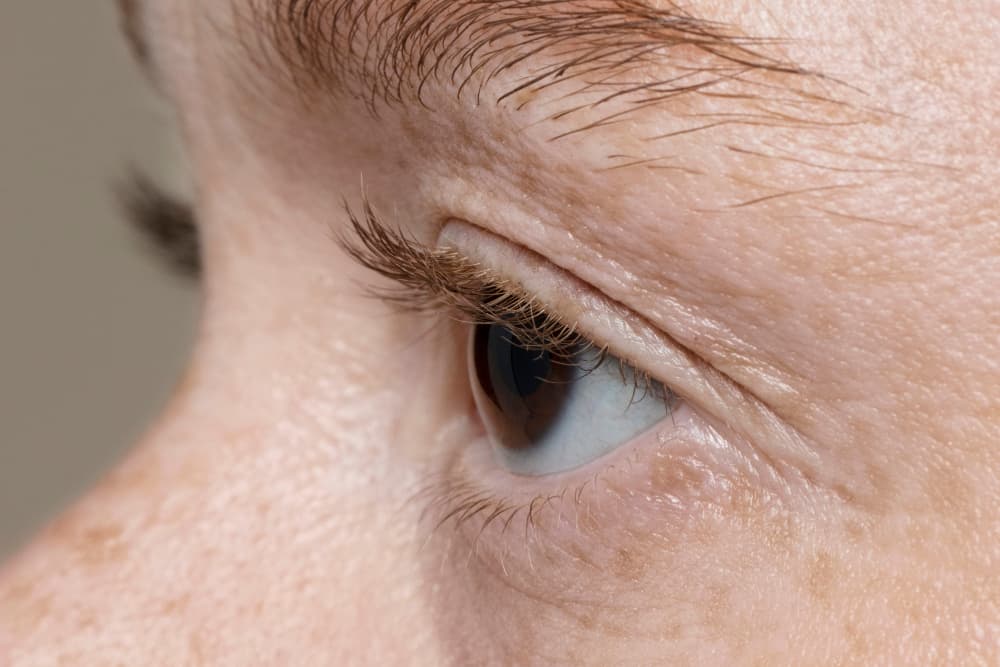 intumescent cataract diagnosis