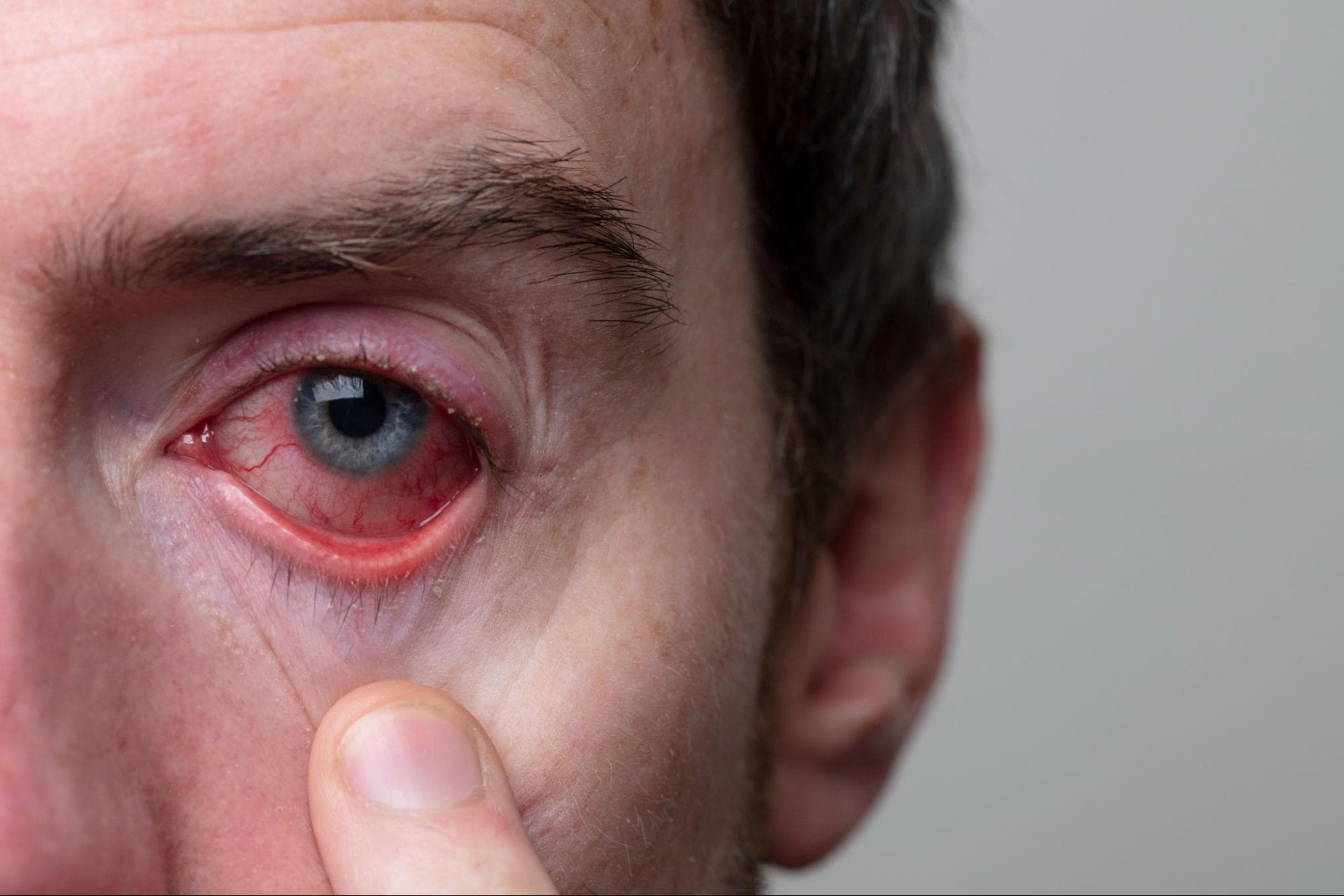 What is Keratitis