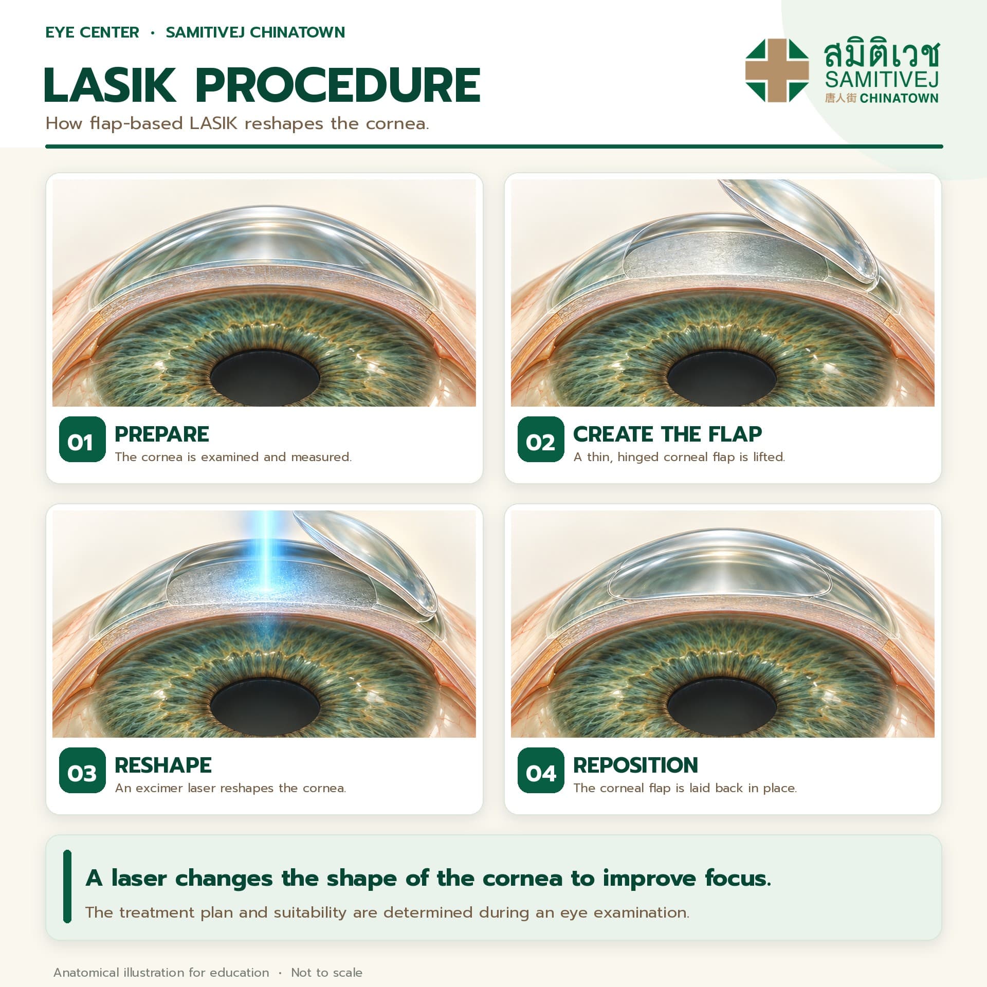 LASIK Procedure