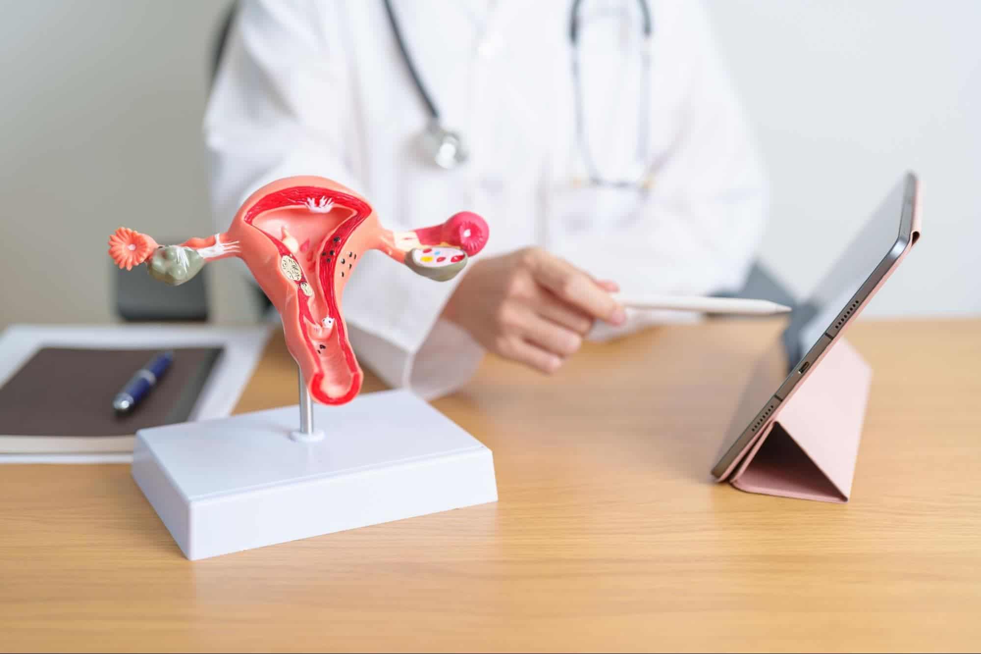 PCOS รักษา