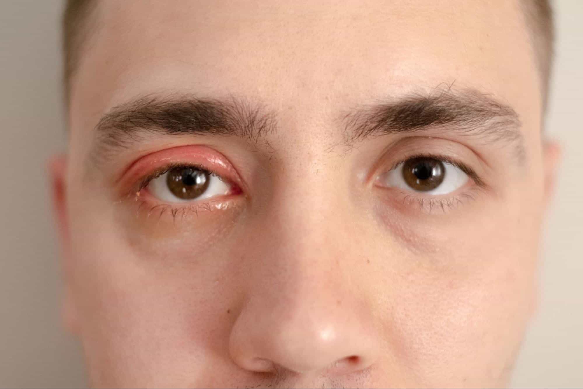 ตาบวม คือ