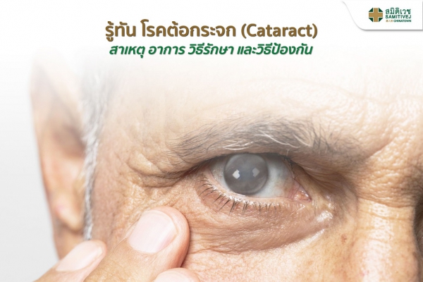 รู้ทัน โรคต้อกระจก (Cataract) สาเหตุ อาการ วิธีรักษา และวิธีป้องกัน