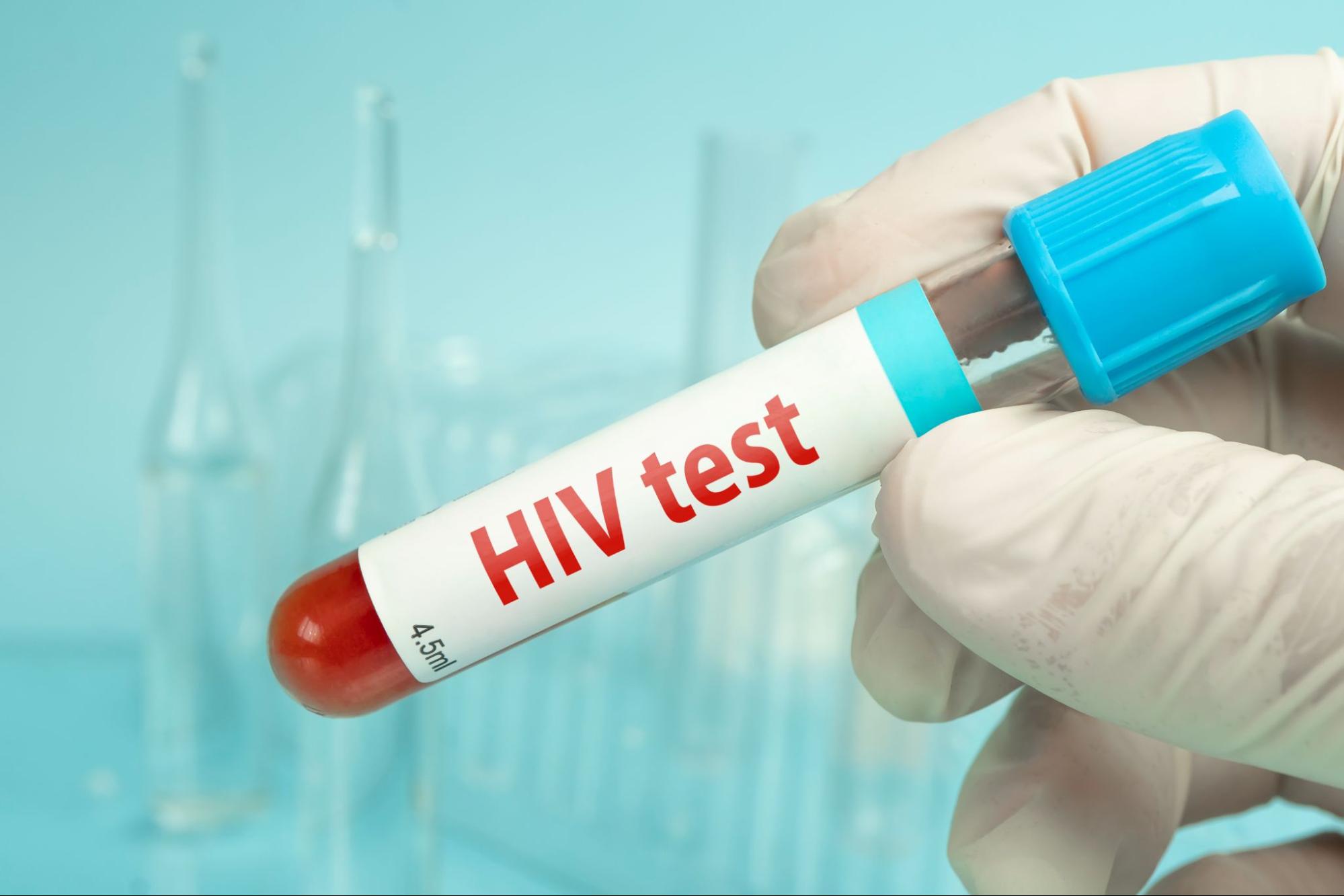HIV คืออะไร ทำความเข้าใจเพื่อรู้เท่าทัน ป้องกันได้