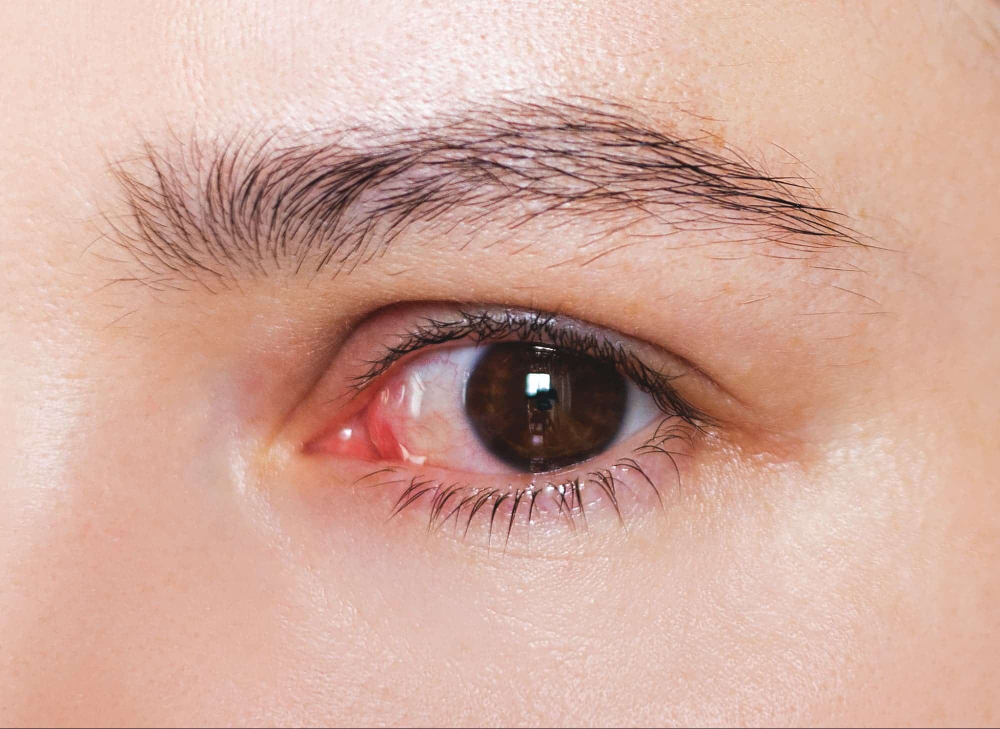 กระจกตาอักเสบ (Keratitis) อาการที่พบ และอันตรายไหม?